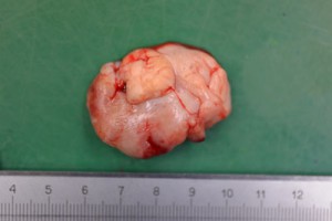 舌腫瘍5s